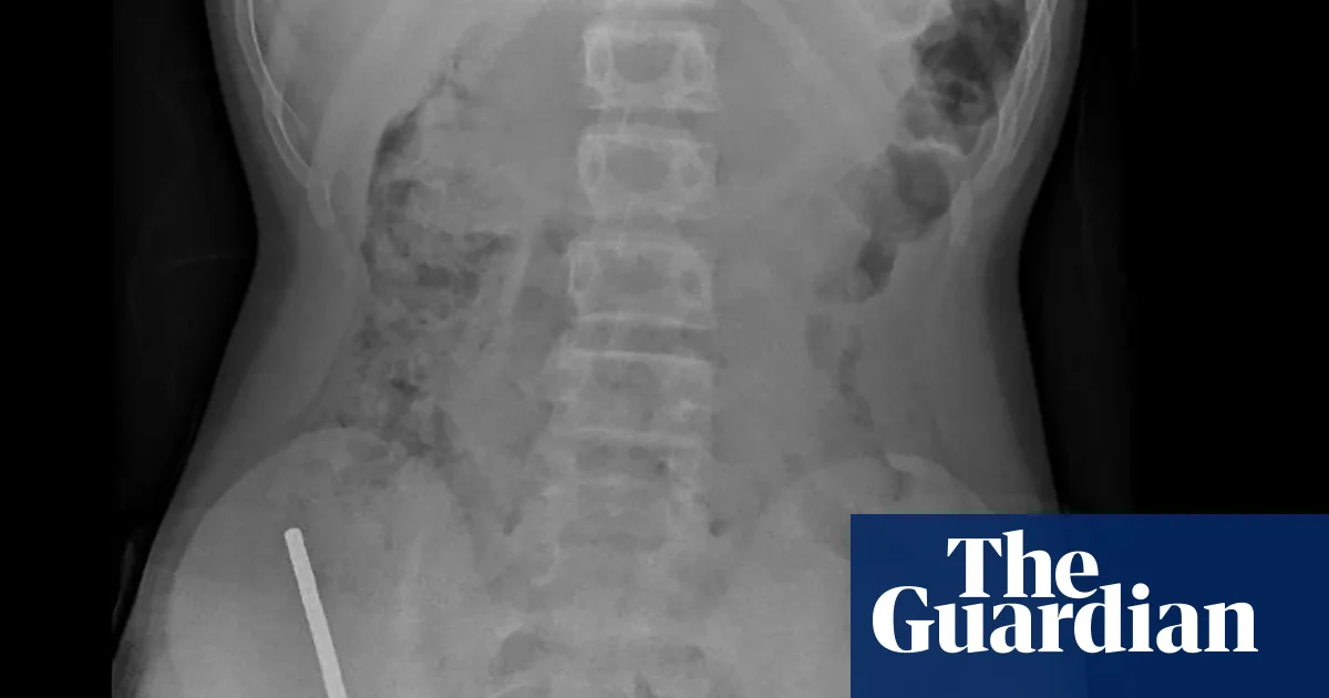 Teenager in New Zealand Saves Himself After Up to 100 Magnets Removed from Intestines